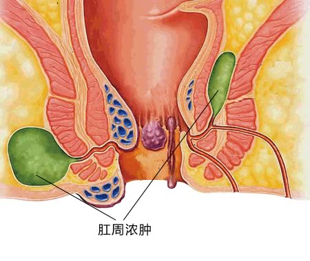 肛周脓肿剖面示意图.jpg