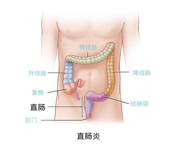 痔疮炎.jpg